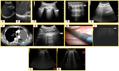 COVID-19 Pneumonia: The Great Ultrasonography Mimicker